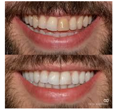Teeth Whitening in Kalyan Nagar